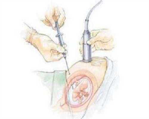 江苏五个月宝宝吐奶怎么办？剖析生理性与消化不良的助孕原因